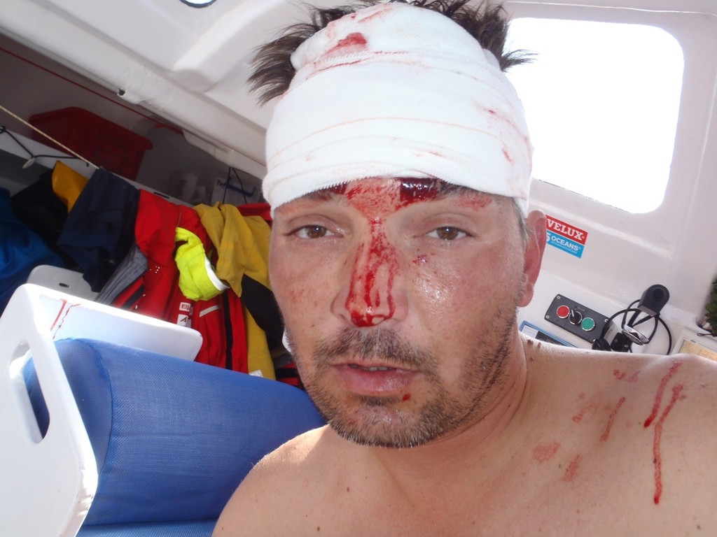 Skipper Zbigniew &rsquo;Gutek&rsquo; Gutkowski shows off an injury to his head which was caused by the blades on his wind generator whilst on the first of five Ocean Sprints in the Velux 5 Oceans race 2010. photo copyright Velux 5 Oceans  taken at  and featuring the  class