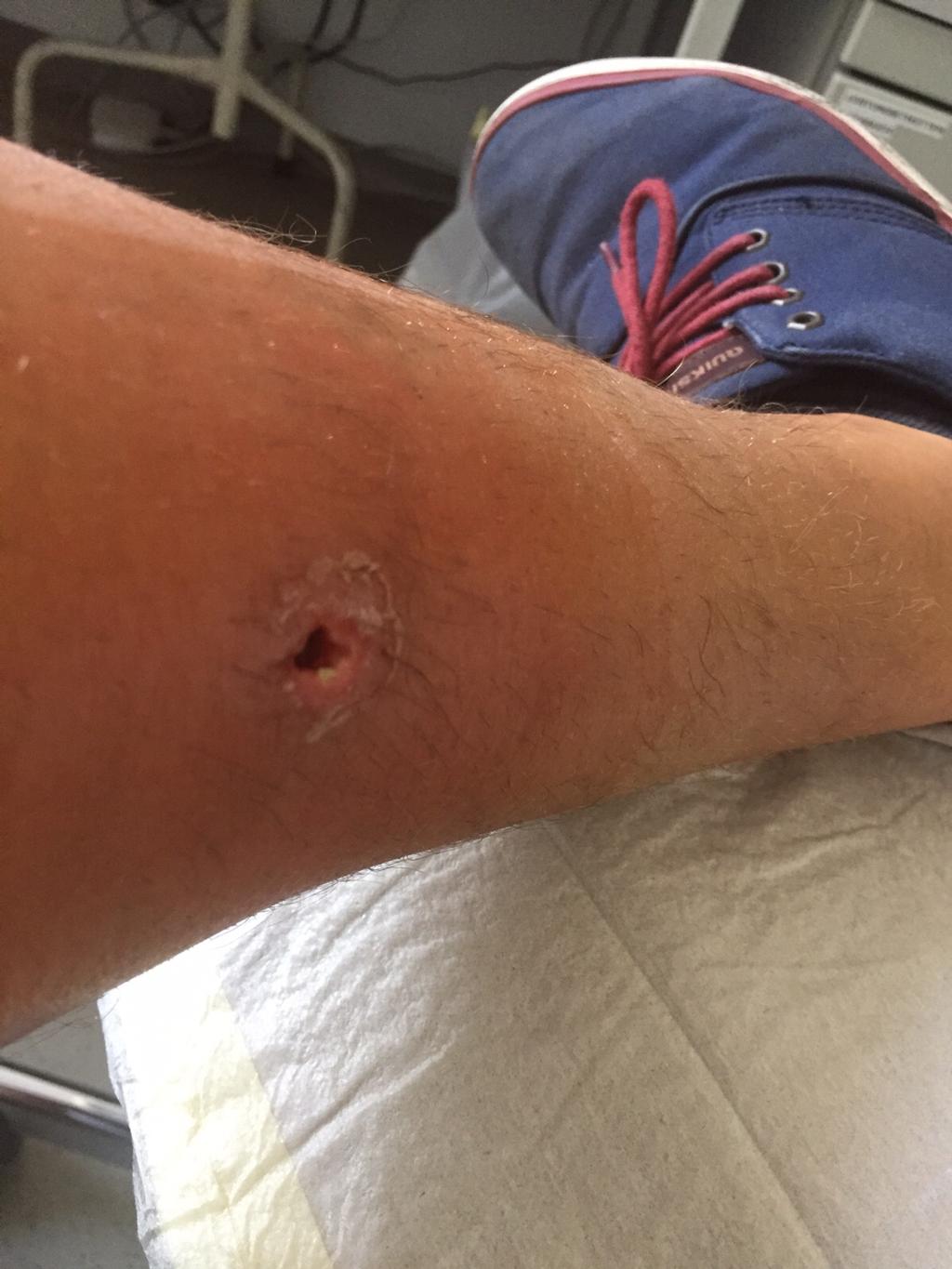 Erik Heil's leg infection continues to be drained, all other inflammatiosnhave healed. © Erik Heil