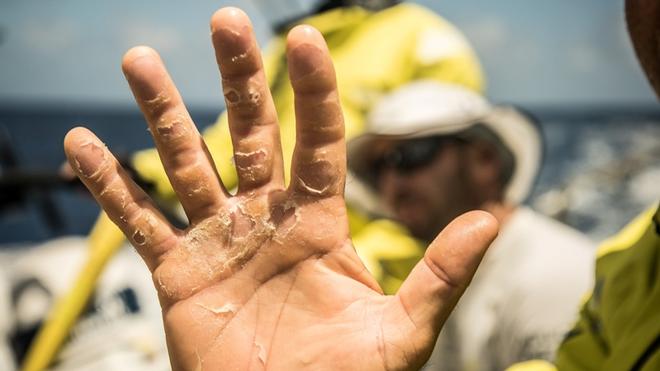 Day 10, Leg 2, Lisbon to Cape Town, Bouwe Bekking shows us his hand after 10 days of racing, 14 November, 2017 – Volvo Ocean Race ©  Rich Edwards / Volvo Ocean Race