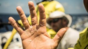 Day 10, Leg 2, Lisbon to Cape Town, Bouwe Bekking shows us his hand after 10 days of racing, 14 November, 2017 – Volvo Ocean Race photo copyright  Rich Edwards / Volvo Ocean Race taken at  and featuring the  class