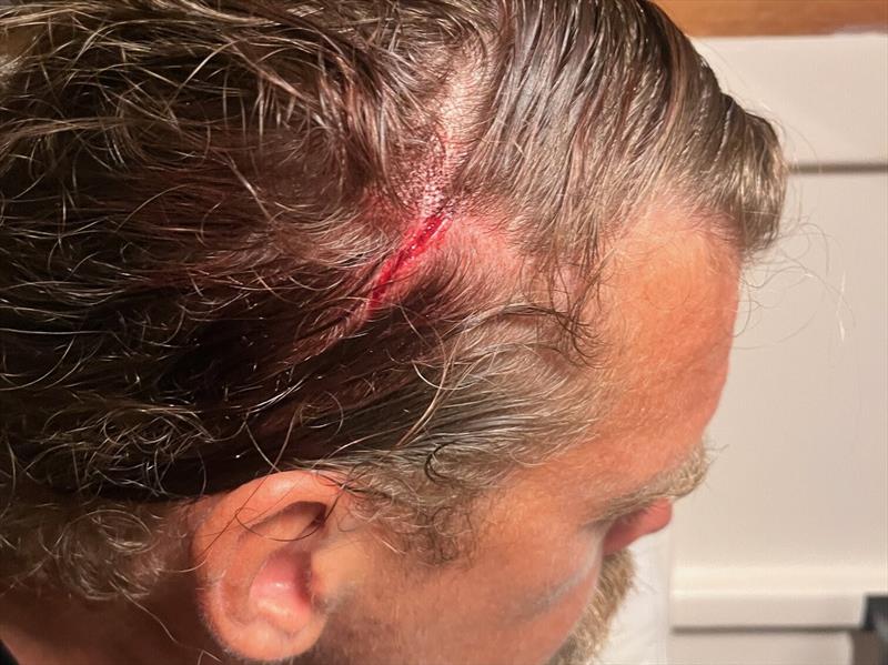 Christian Sauer (#103 Argo / DE ) head butt the boom! blood, groove, headache , but all OK and wondering WHY? because he knew HOW!!! …..OUCH!! - photo © Christian Sauer / MGR2025