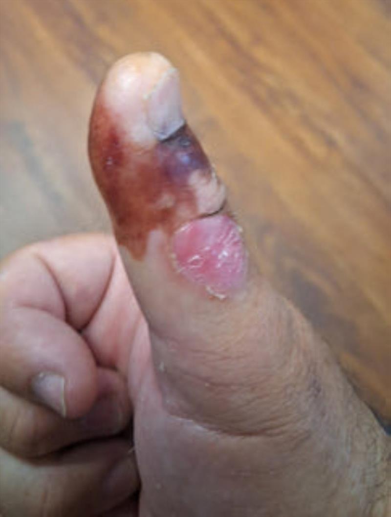 Garry reached down to unsnag his cast net in Eli Creek and was spiked by a stonefish. Hot water is the only treatment, so burnt skin is a side effect - photo © Fisho's Tackle World