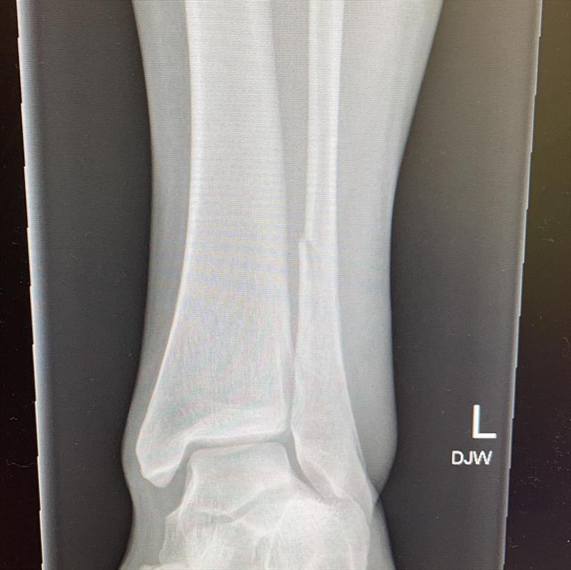 X-Ray of leg - Erica Dawson injured in Nacra 17 training - June 2021 photo copyright Erica Dawson Archives taken at Royal Akarana Yacht Club and featuring the Nacra 17 class