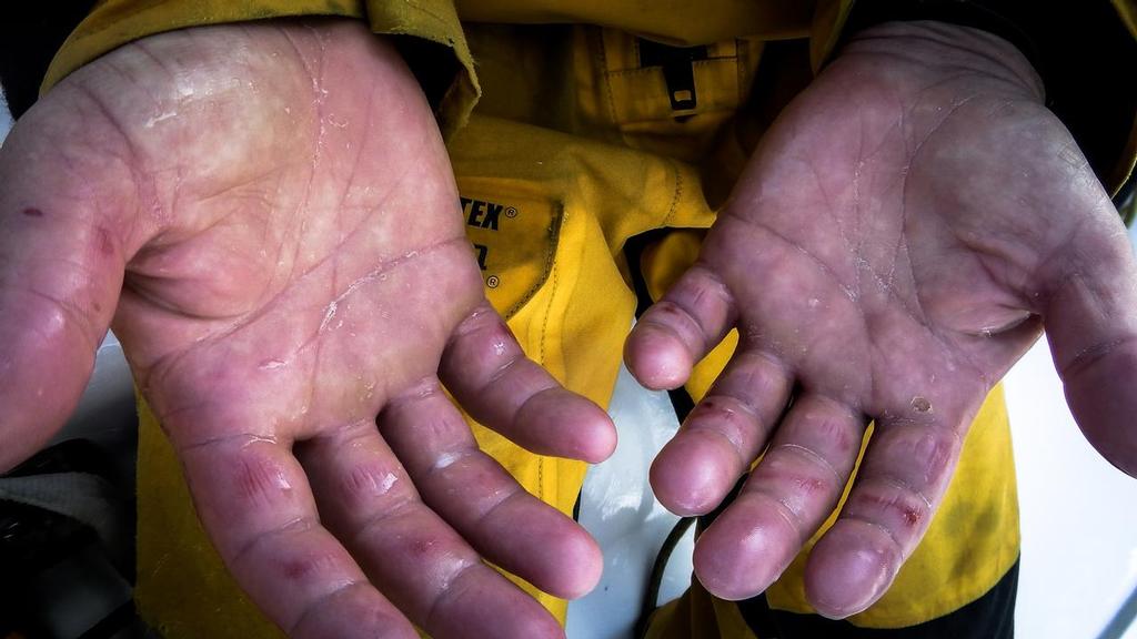 August 14, 2014. Round Britain Island Race Day 4 - OBR content Abu Dhabi Ocean Racing: Phil Harmer blistered fingers photo copyright  Justin Chisholm / Abu Dhabi Ocean Racing http://www.volvooceanrace.com taken at  and featuring the  class